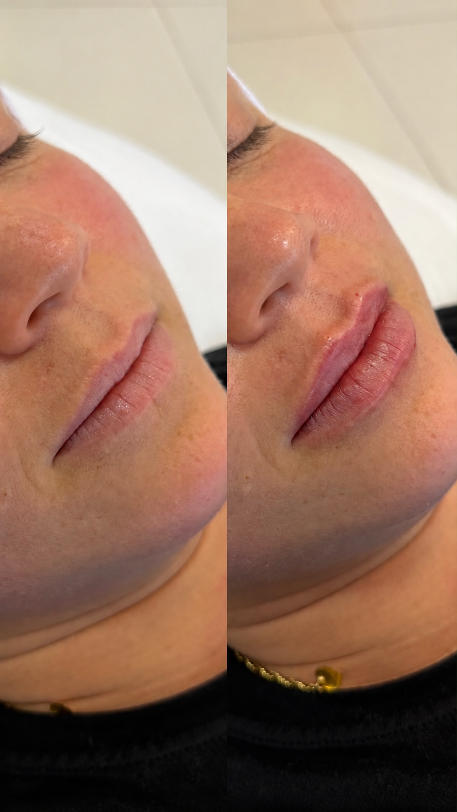 Antes e depois real de preenchimento labial